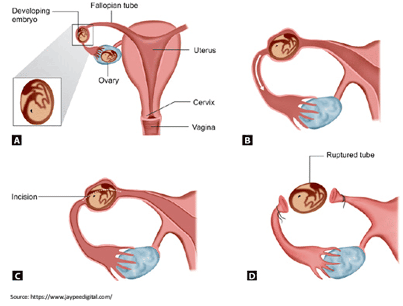 ectopic pregnancy