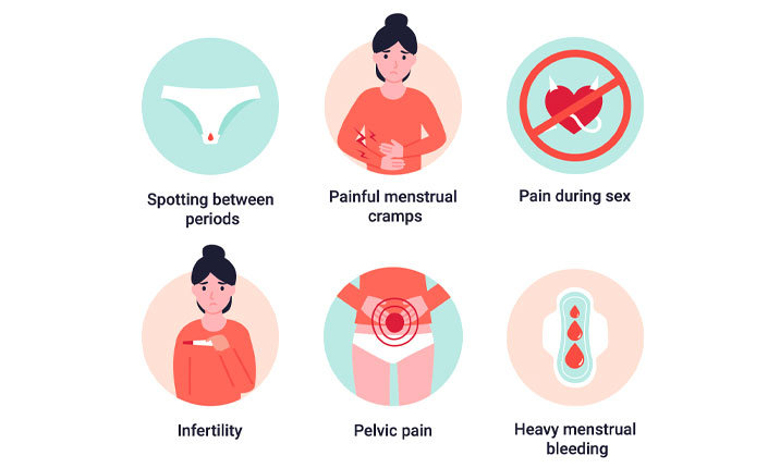 Dealing with Endometriosis | Health Plus