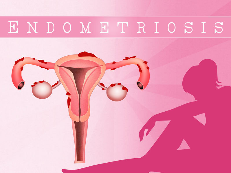 3 Facts About Endometriosis: Can I Still Get Pregnant? - ReUnite Rx