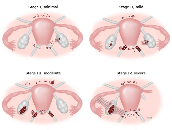 Patient Information - Brisbane Centre for Endometriosis