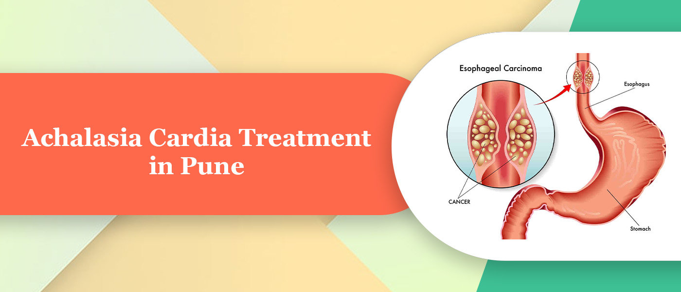 Achalasia-Cardia Achalasia-Cardia