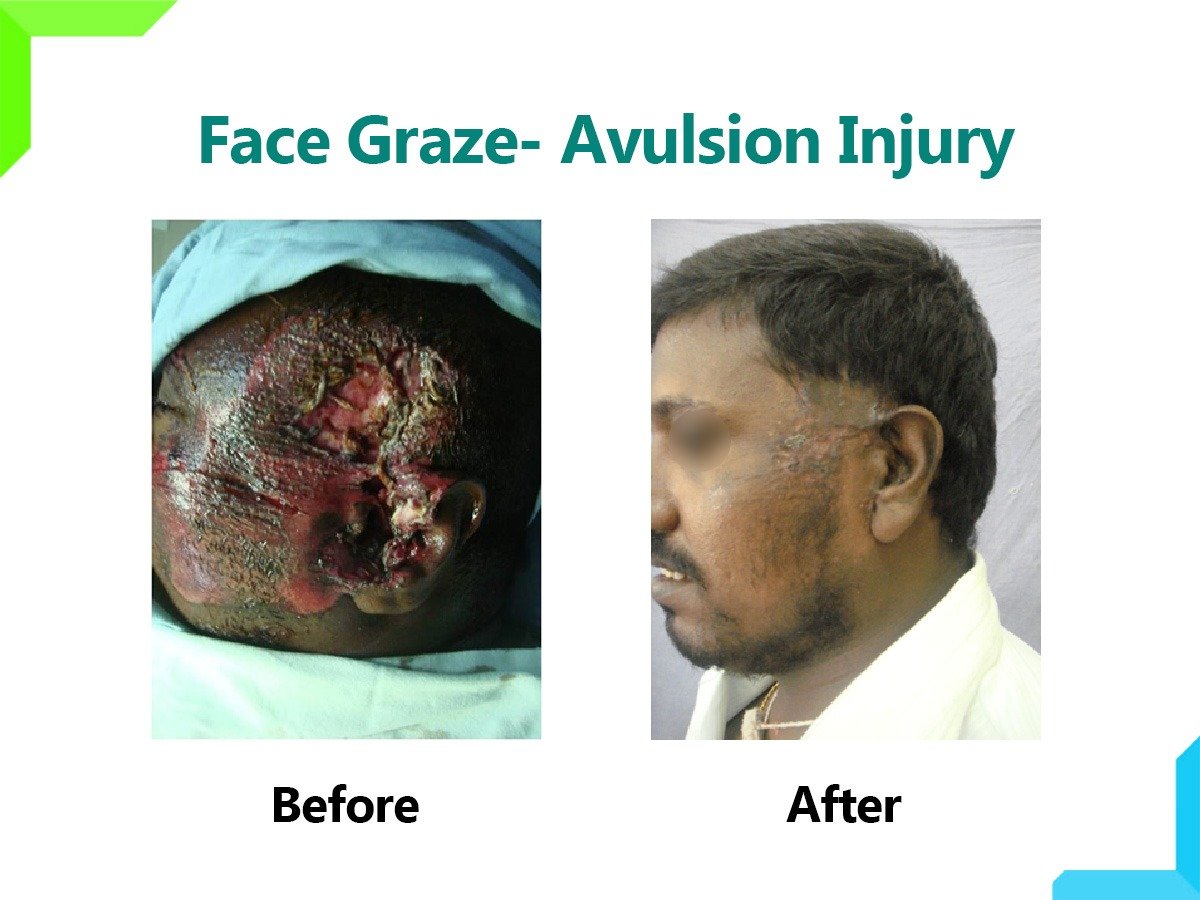 Face Graze- Avulsion Injury Face Graze- Avulsion Injury