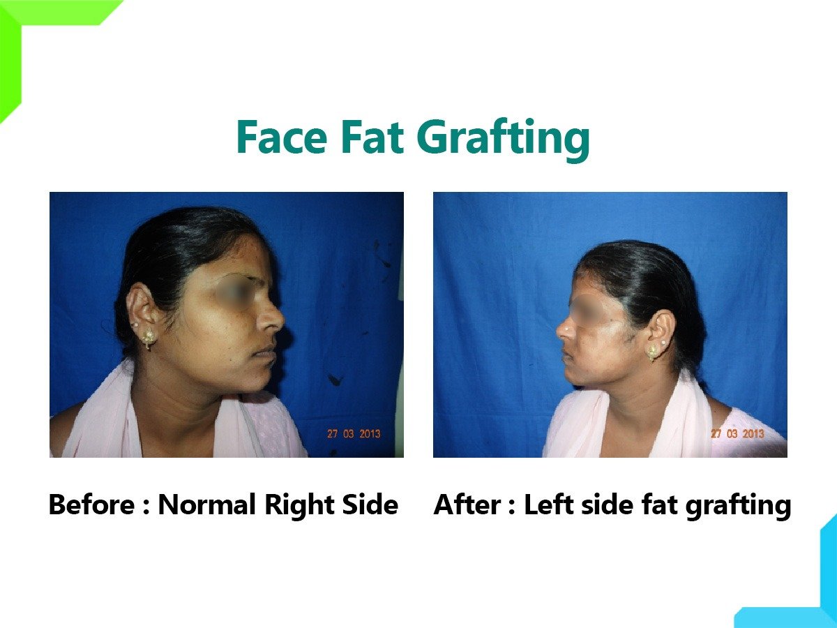 Face Fat Grafting Face Fat Grafting