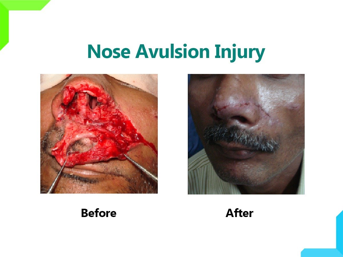 Nose Avulsion Injury Nose Avulsion Injury