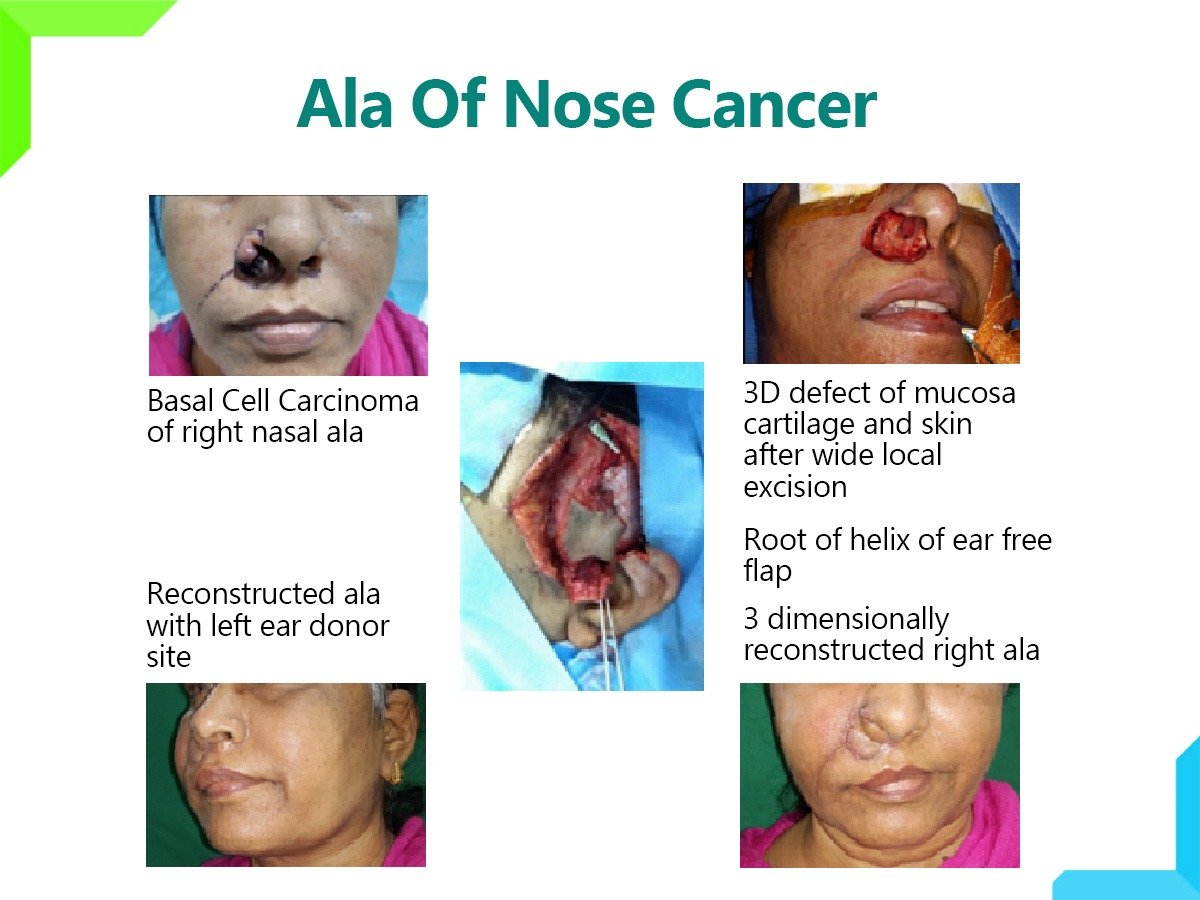 Ala Of Nose Cancer Ala Of Nose Cancer