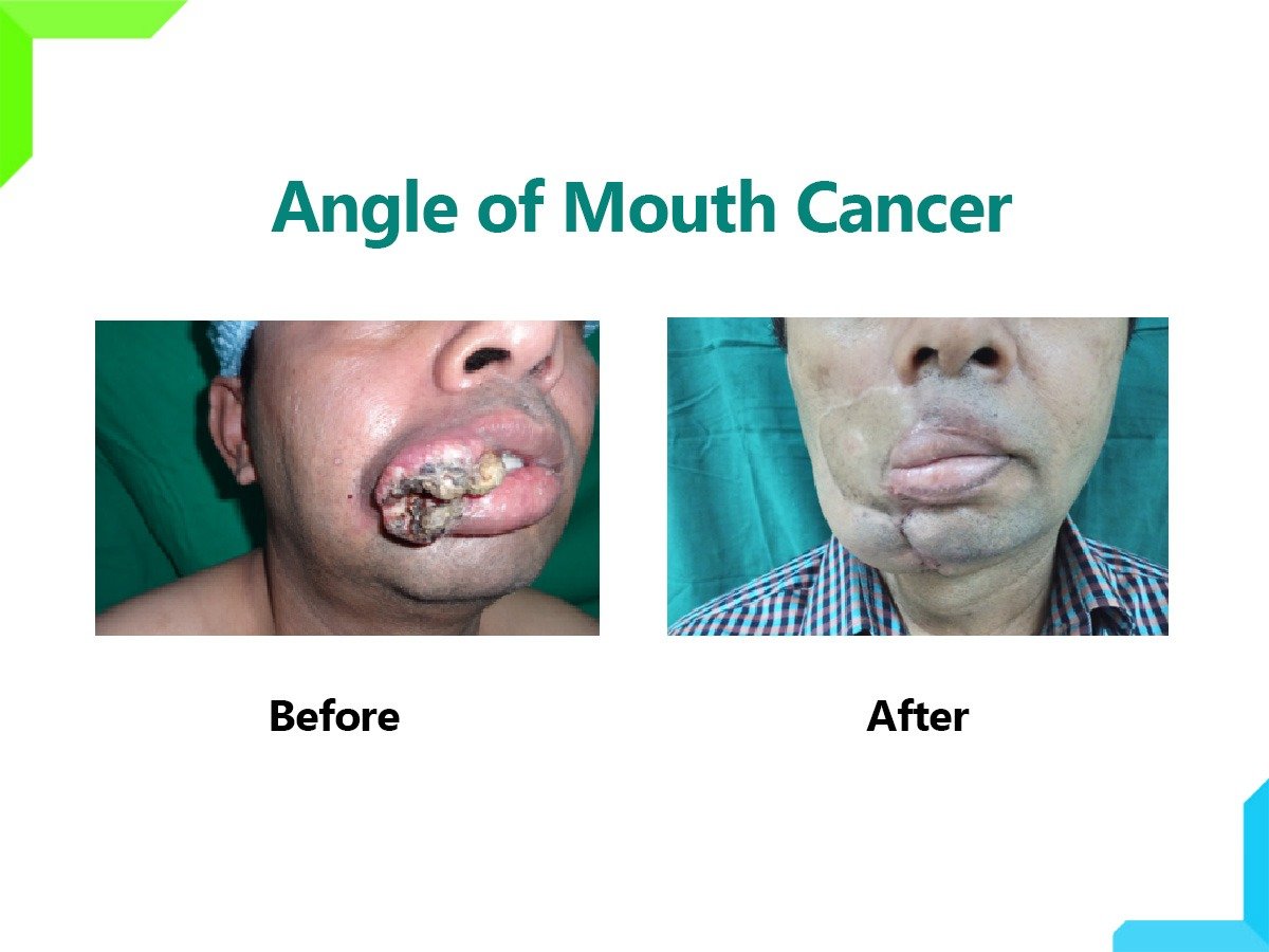 Angle of Mouth Cancer Angle of Mouth Cancer