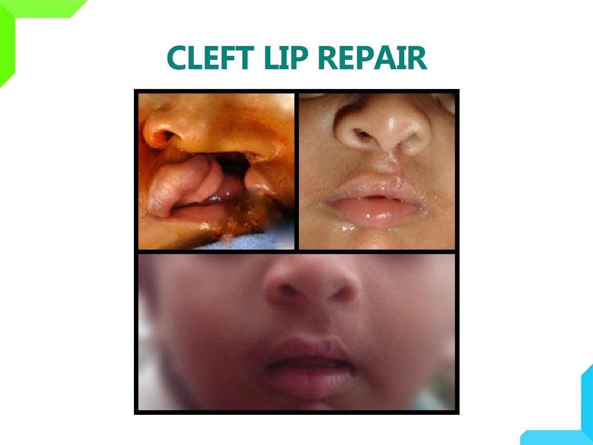 CLEFT LIP REPAIR CLEFT LIP REPAIR