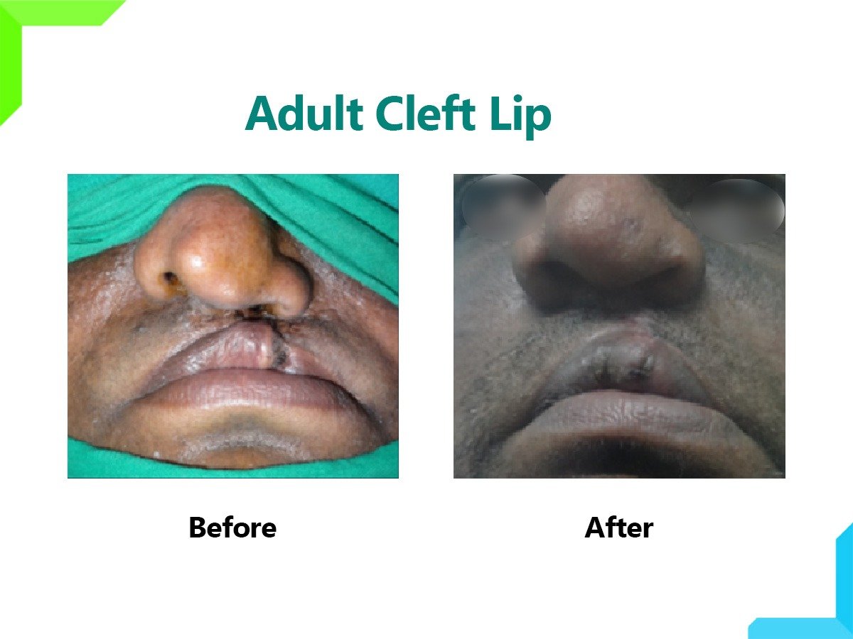 Adult Cleft Lip Adult Cleft Lip