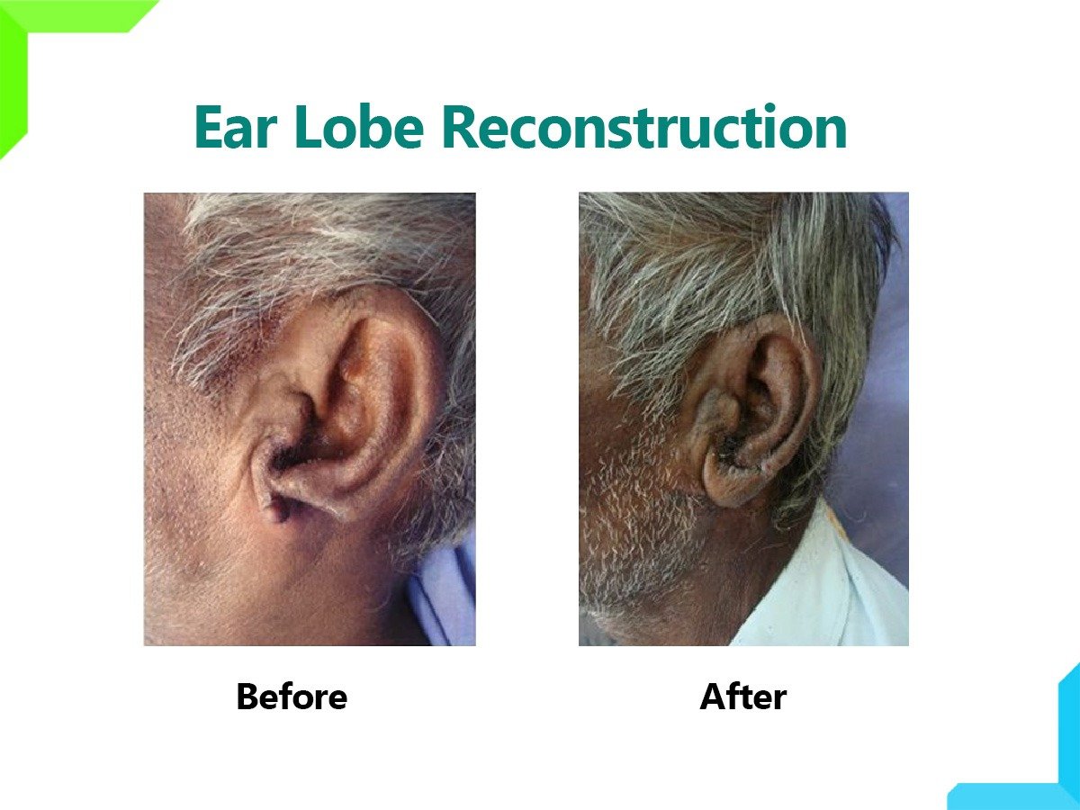 EAR LOBE RECONSTRUCTION EAR LOBE RECONSTRUCTION