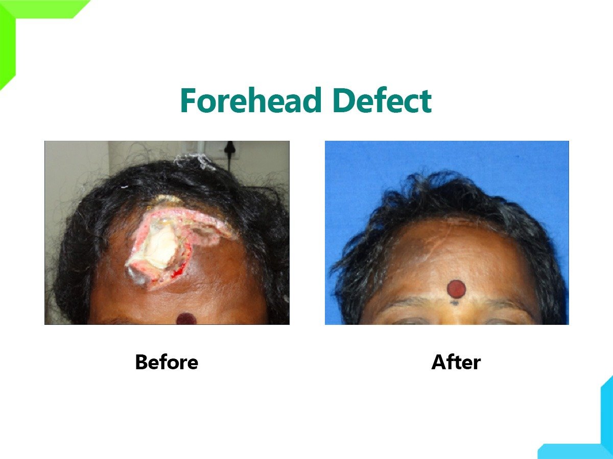 FOREHEAD DEFECT FOREHEAD DEFECT