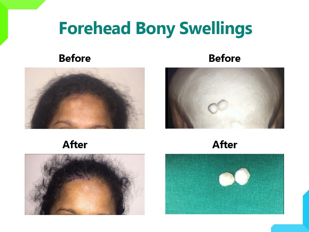 Forehead Bony Swellings Forehead Bony Swellings