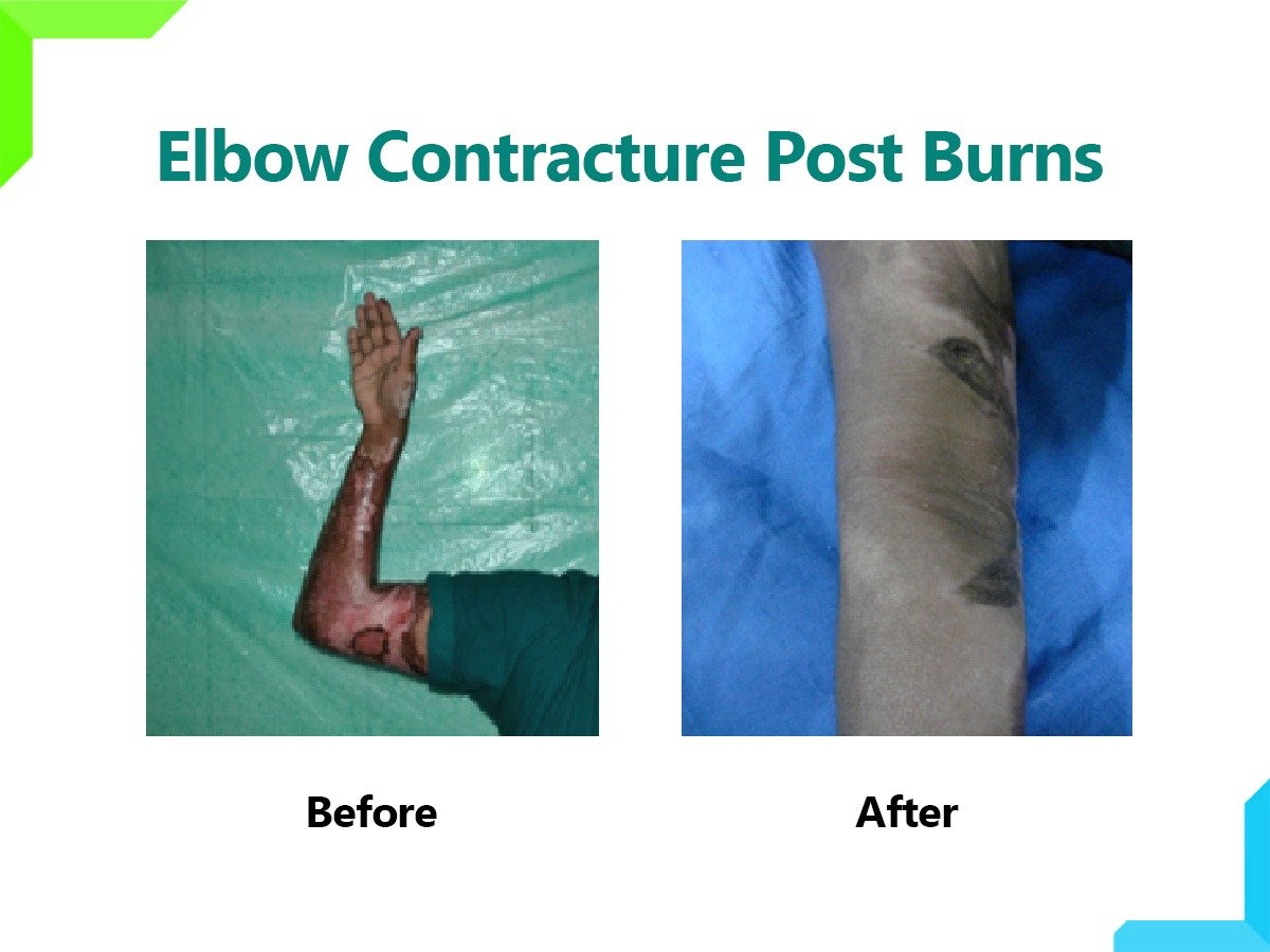 ELBOW CONTRACTURE POST BURNS ELBOW CONTRACTURE POST BURNS