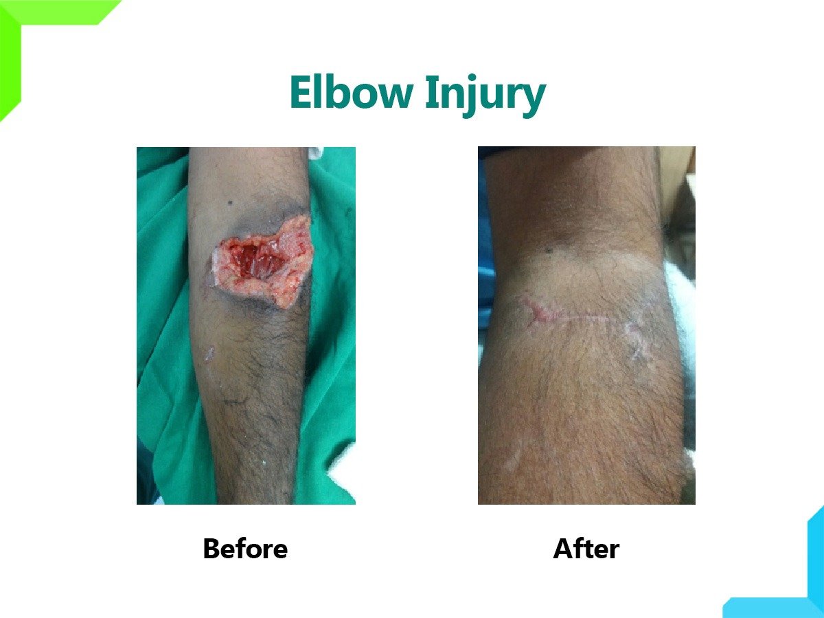 Elbow Injury Elbow Injury