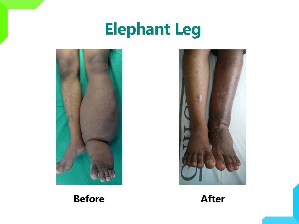 Elephant Leg Elephant Leg