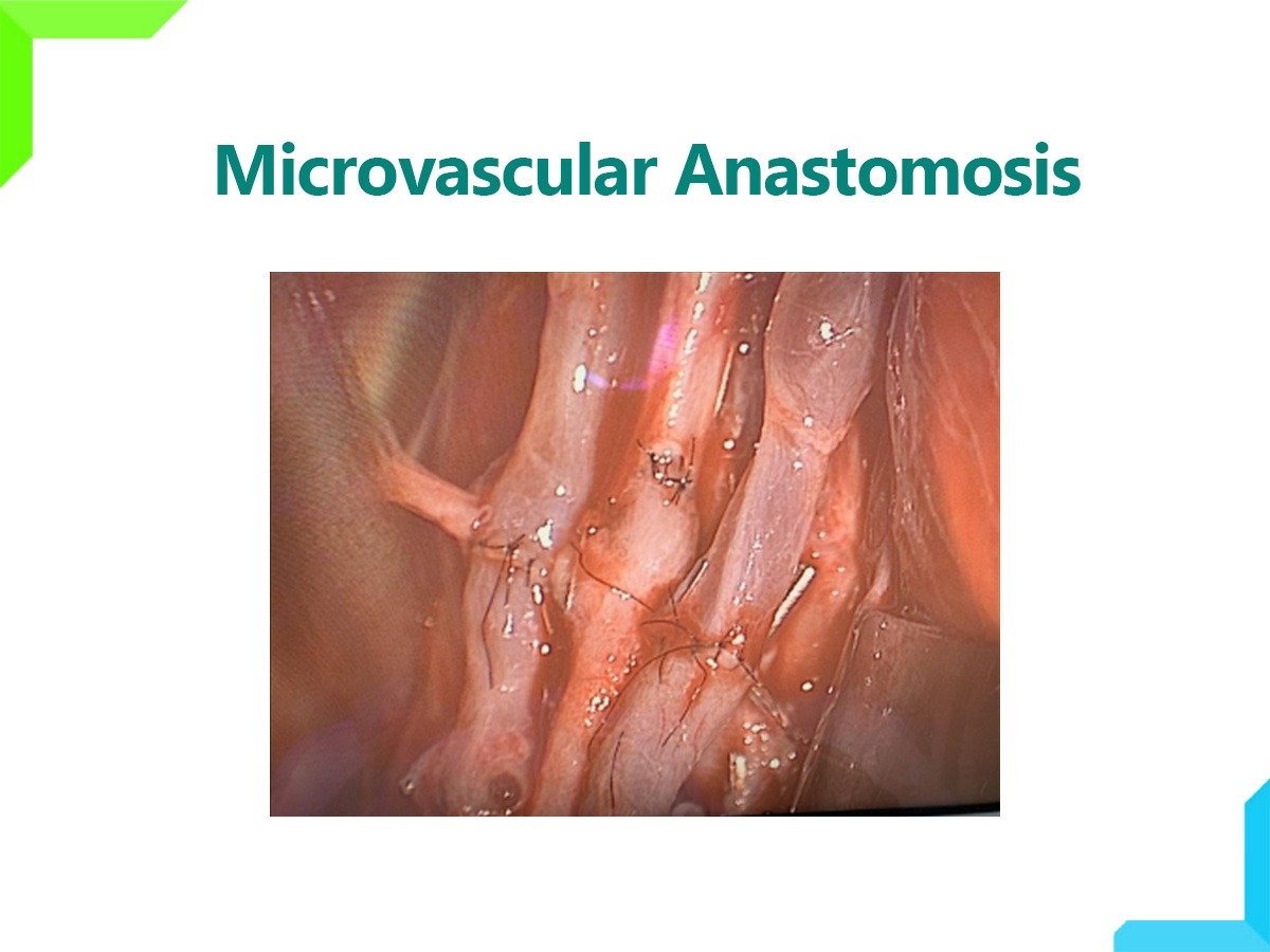 Microvascular Anastomosis Microvascular Anastomosis