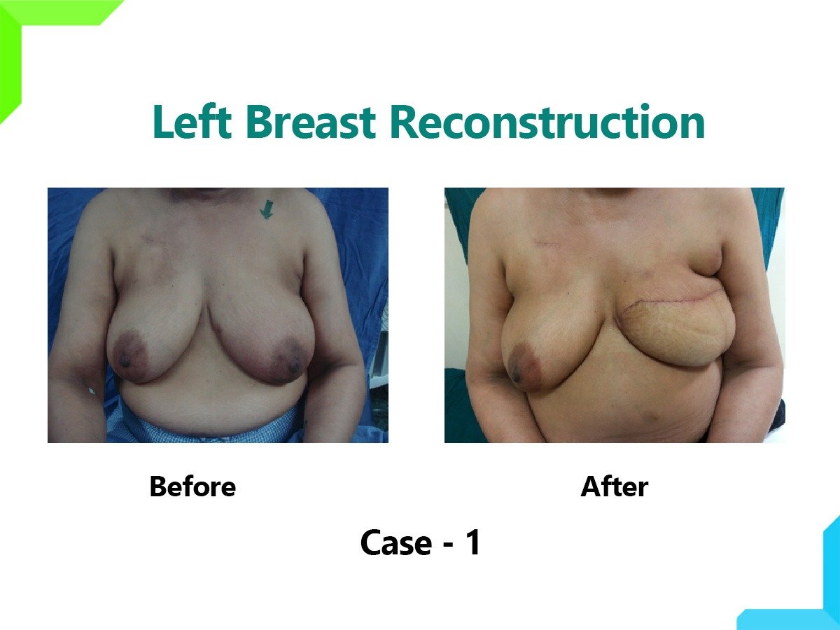 Breast Reconstruction Breast Reconstruction