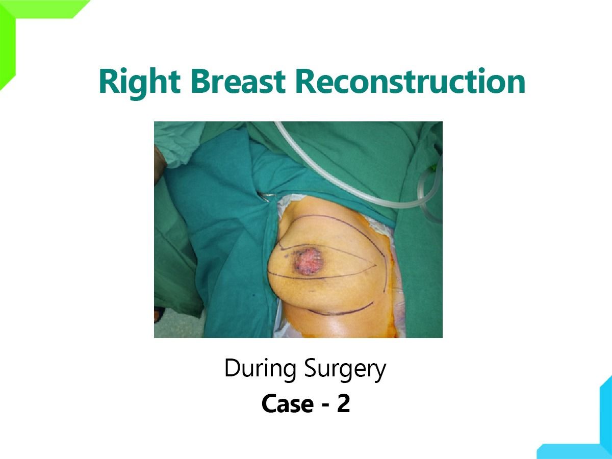 Right Breast Reconstruction
