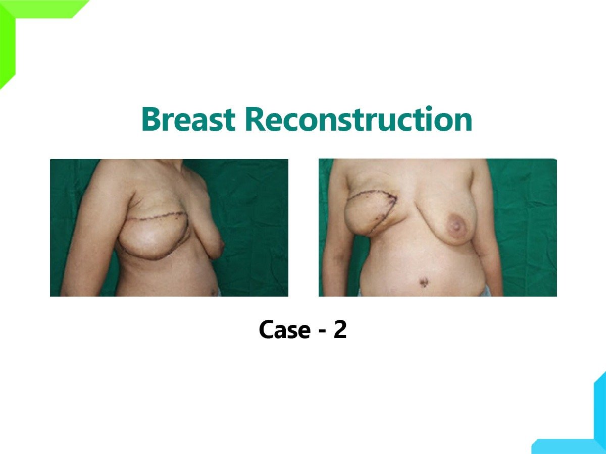 Breast Reconstruction Breast Reconstruction