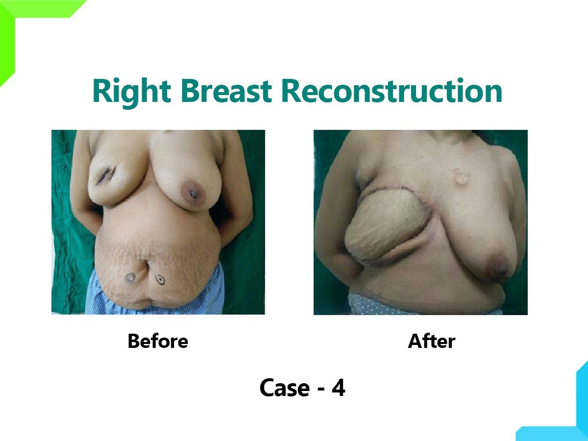 Right Breast Reconstruction Right Breast Reconstruction