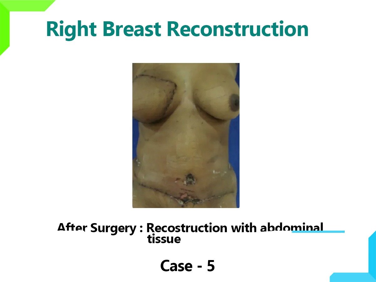 Right Breast Reconstruction Right Breast Reconstruction