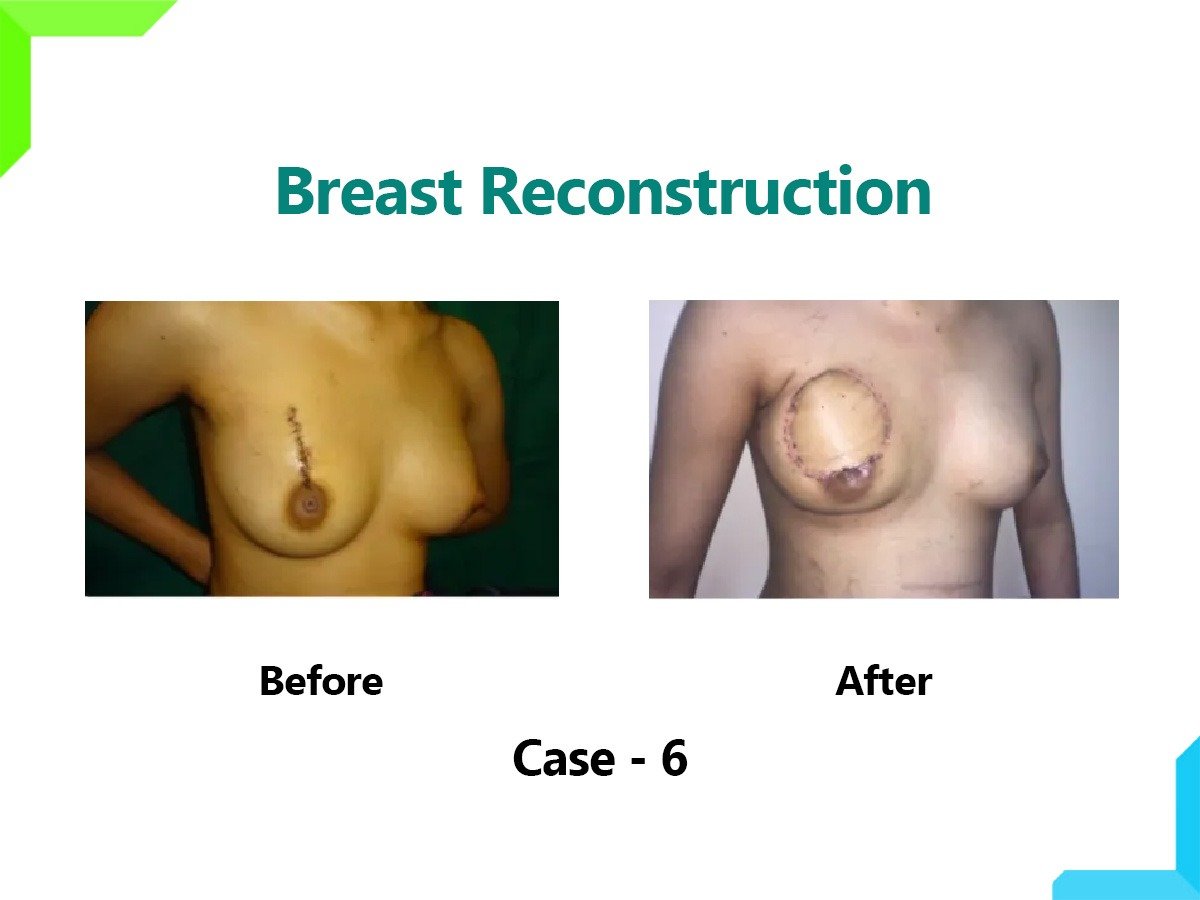 Breast Reconstruction Breast Reconstruction