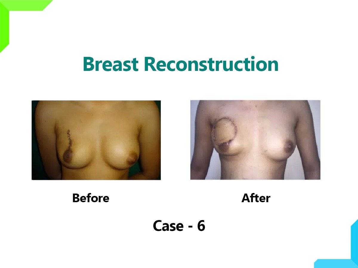 Breast Reconstruction Breast Reconstruction