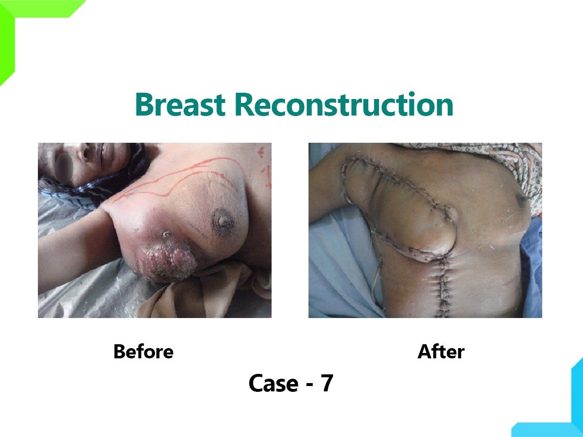 Breast Reconstruction Breast Reconstruction