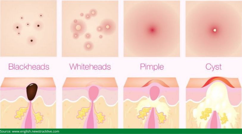  types of acne