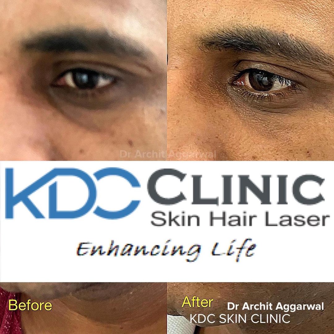 under eye filler under eye filler