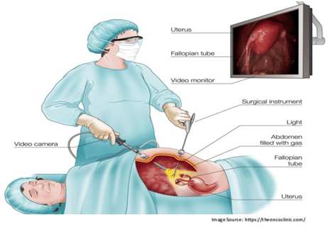 Laparoscopic Cancer Surgery