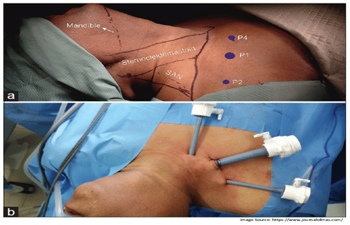 Minimally Invasive Neck Dissection 