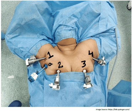 RoboticAssisted Breast-Axillo Insufflate Thyroidectomy