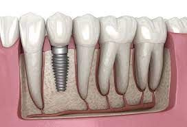 Dental implant - Wikipedia