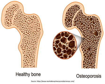 Osteoporosis