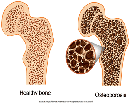  Osteoporosis