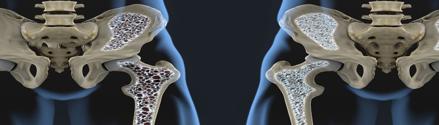 Osteoporosis Osteoporosis