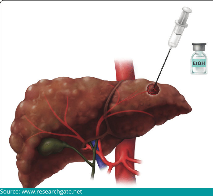 Percutaneous ethanol injection