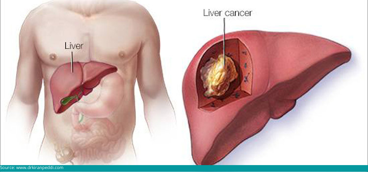 liver cancer