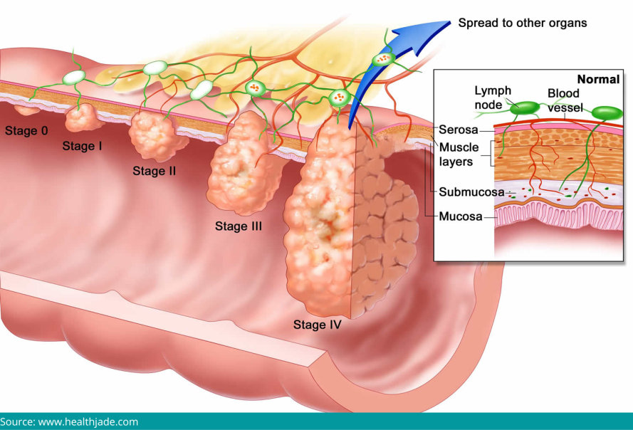 esophageal cancer