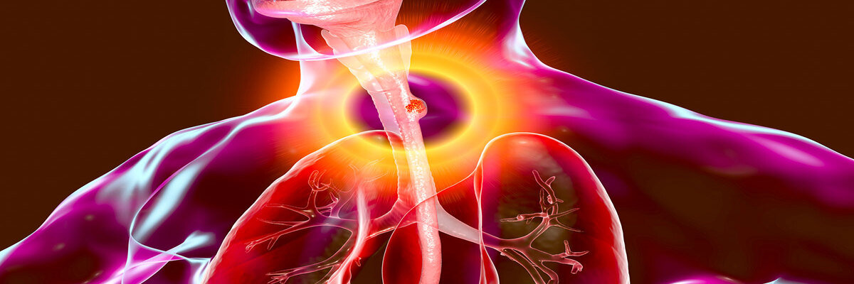 Esophageal Cancer Esophageal Cancer