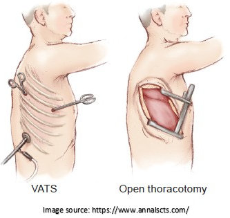 lung cancer surgery