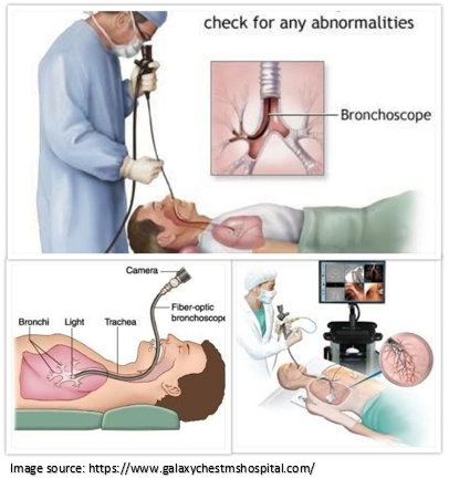 lung cancer surgery