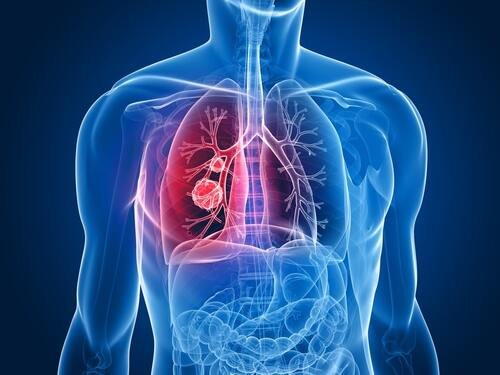 lung cancer treatment