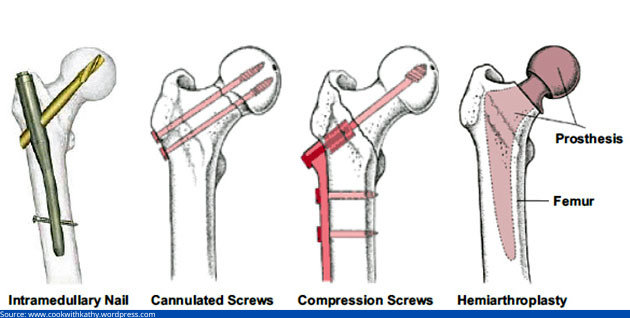 hip fracture repair