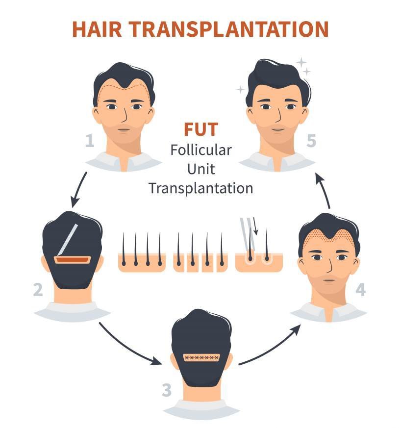 FUT Hair Transplant by Dr.J – Follicular Unit Transplant Orlando