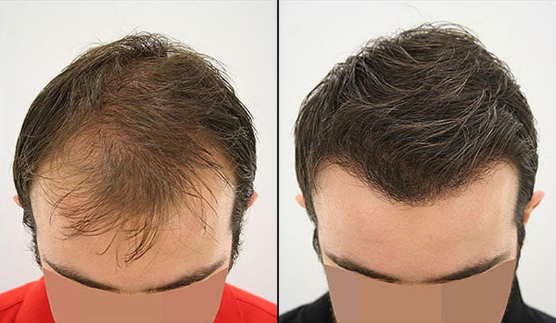 Hair transplant in Iran| The success rate of Hair transplant in men & women