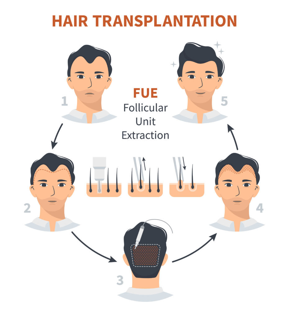 Sapphire FUE Hair Transplantation - İberia Clinic
