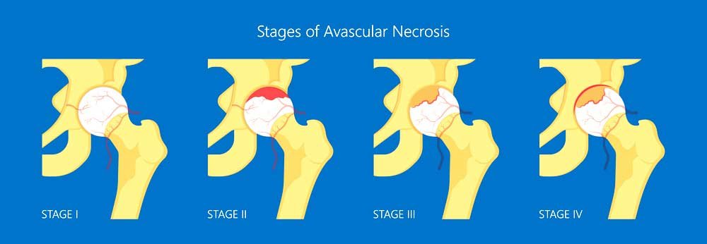 Hip Avascular Necrosis (Osteonecrosis) | AVN | Necrosis of the Femoral Head  | Manhattan, New York City, NY