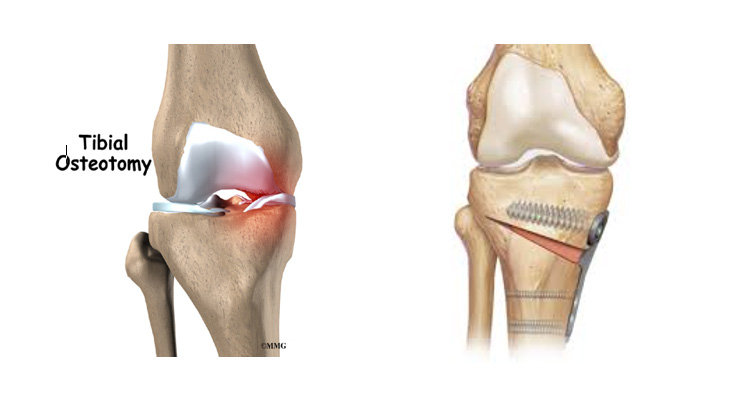 High Tibial Osteotomy - Dr Lingaraju