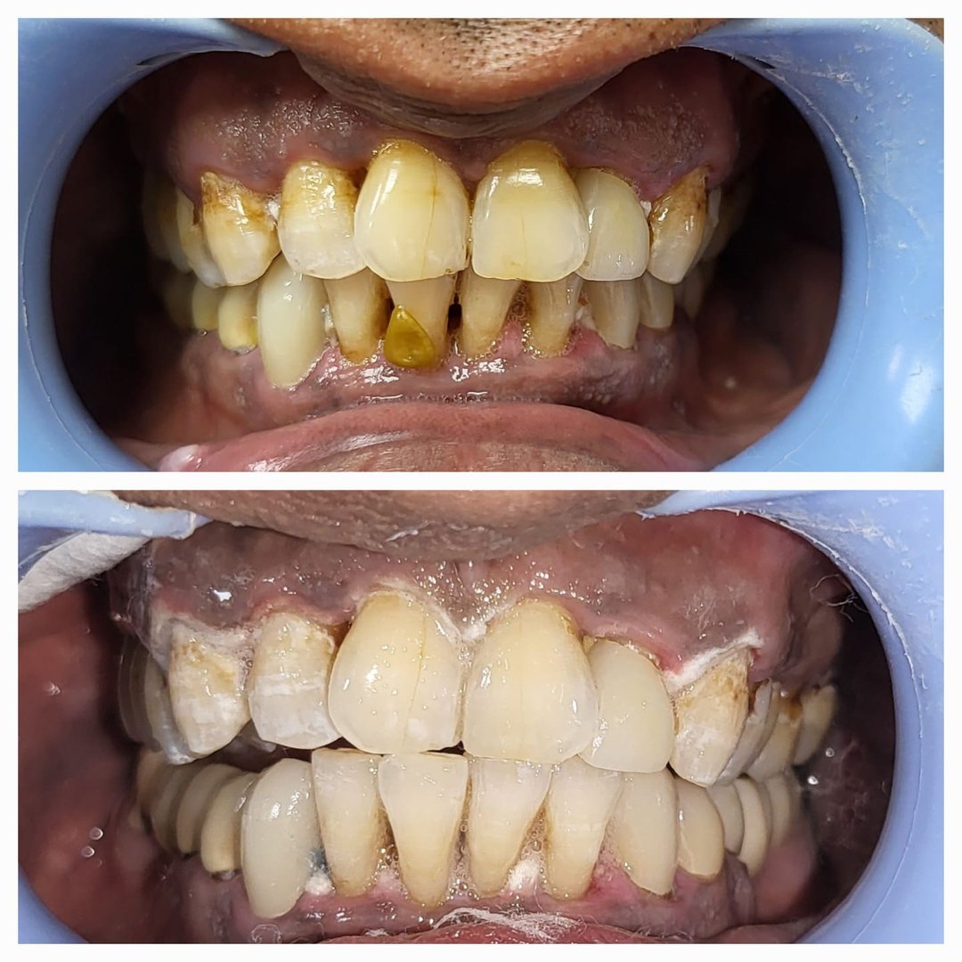Single sitting laser teeth whitening Single sitting laser teeth whitening